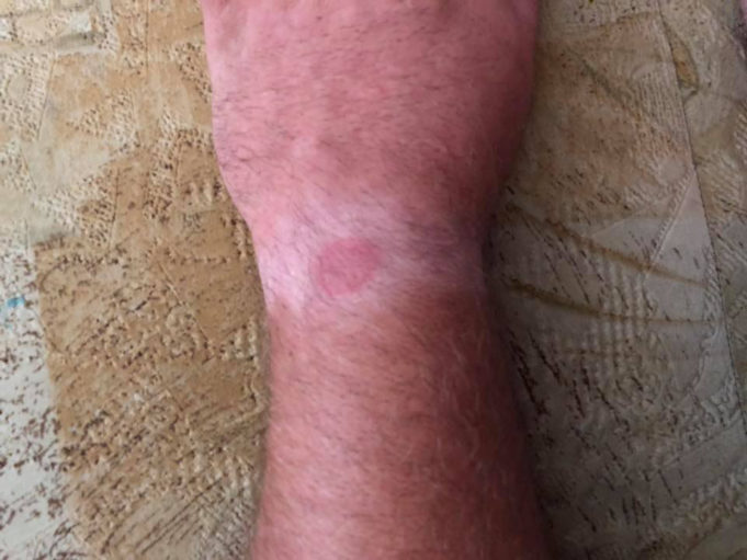 Pozor na alergickou reakci na kůži z Apple Watch